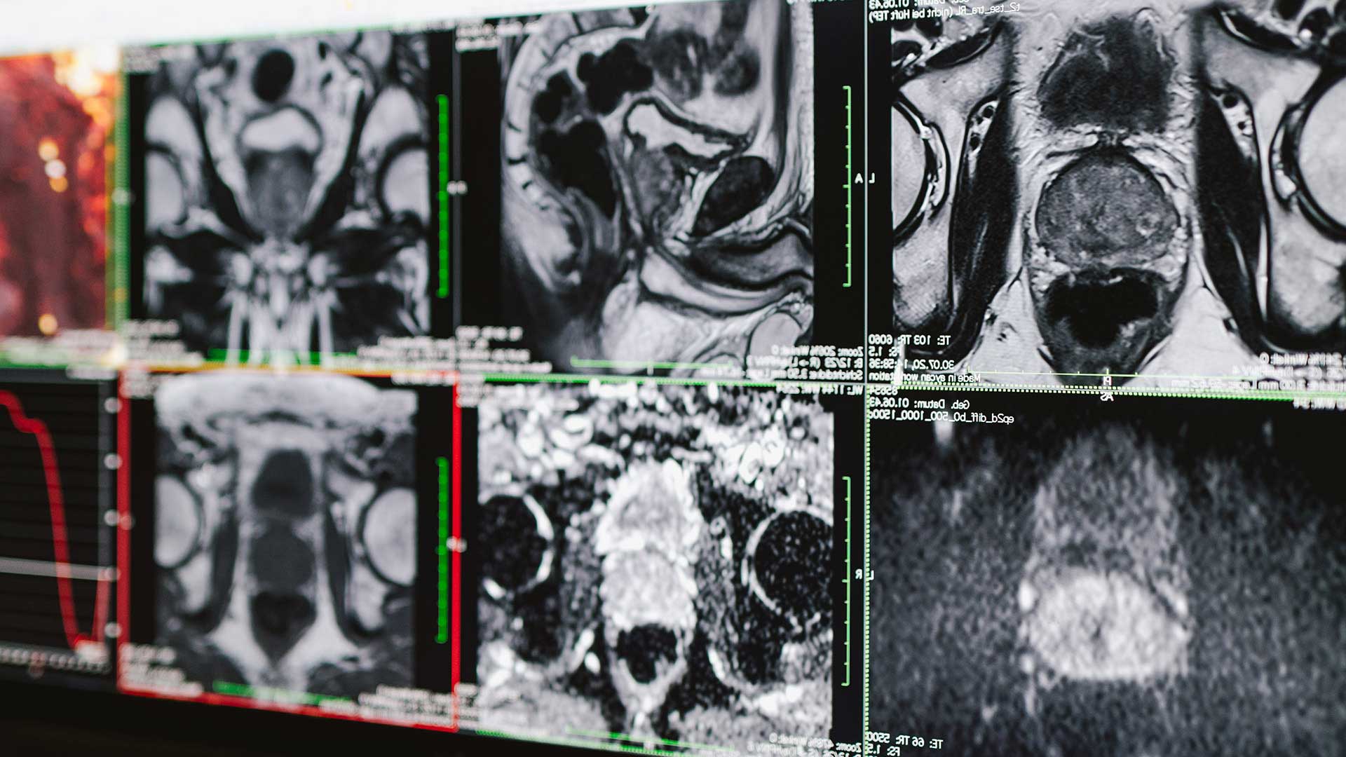 Prostatadiagnostik / Prostata-MRT in der Radiologie Heinrichsallee, Aachen