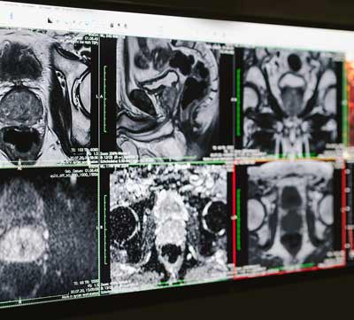 Prostata-MRT Bilder der Radiologie Aachen